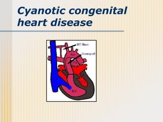Cyanotic congenital
heart disease
 