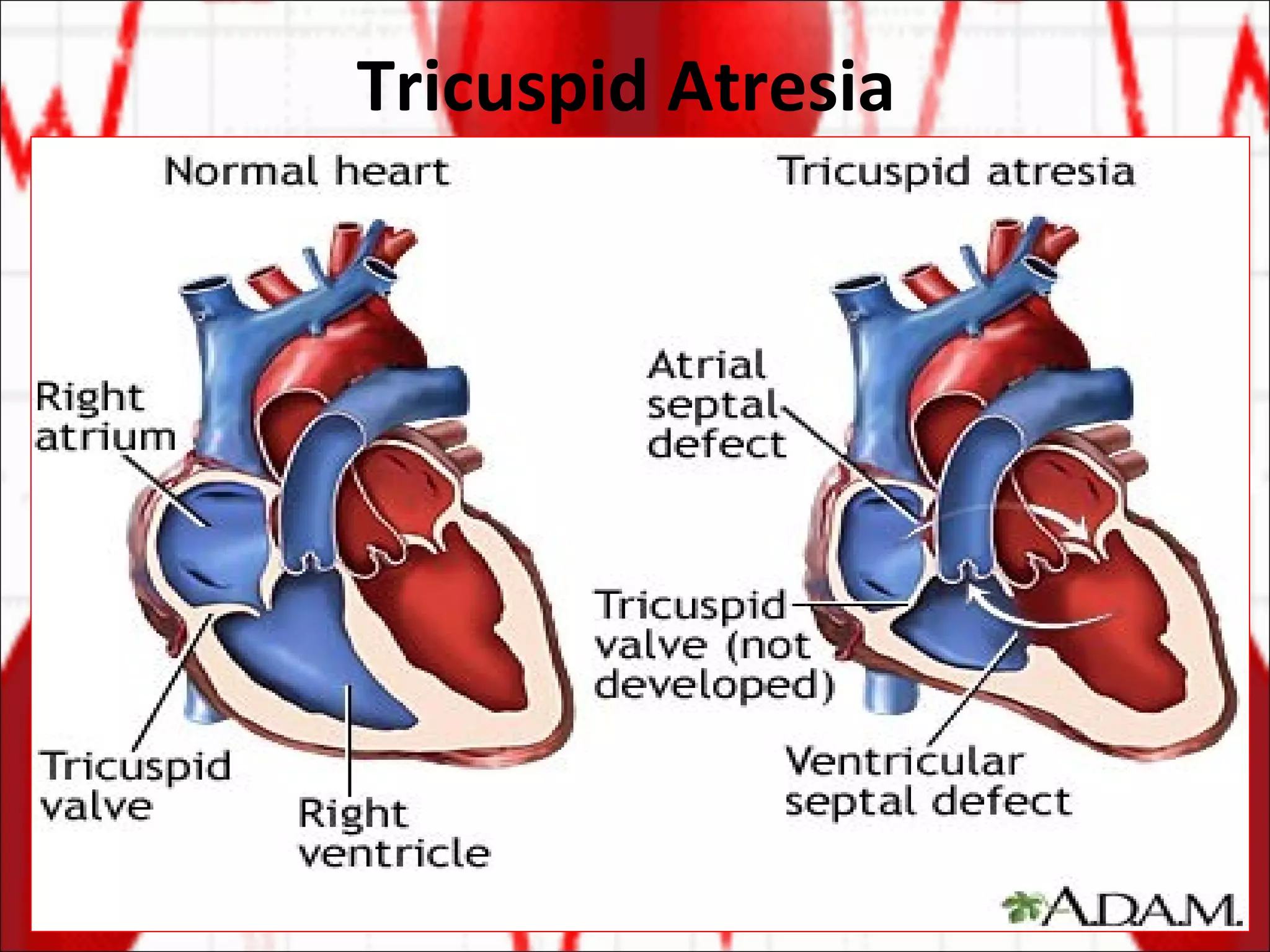 Tricuspid Atresia  