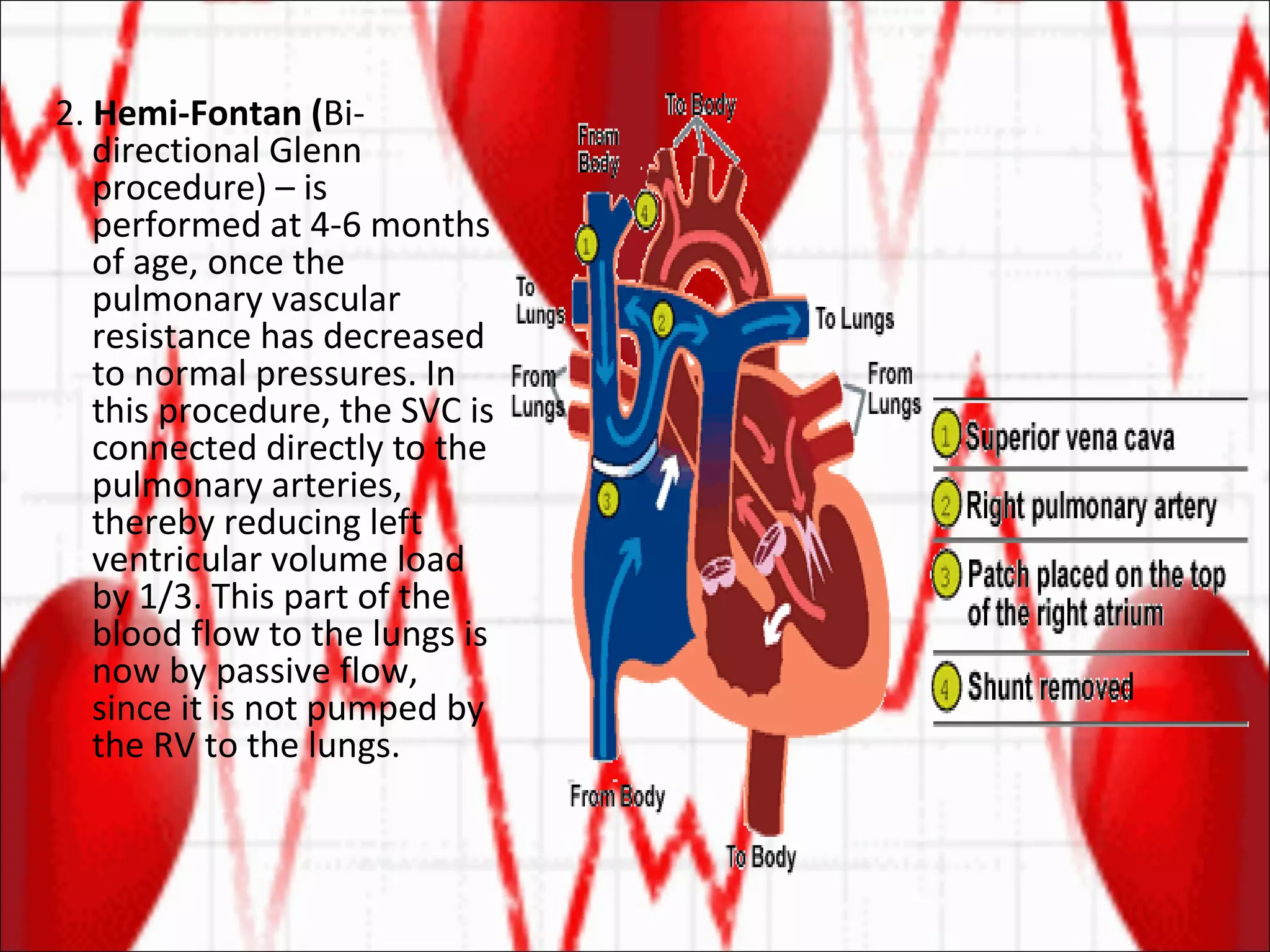 2.  Hemi-Fontan ( Bi-directional Glenn procedure) – is performed at 4-6 months of age, once the pulmonary vascular resistance has decreased to normal pressures. In this procedure, the SVC is connected directly to the pulmonary arteries, thereby reducing left ventricular volume load by 1/3. This part of the blood flow to the lungs is now by passive flow, since it is not pumped by the RV to the lungs. 