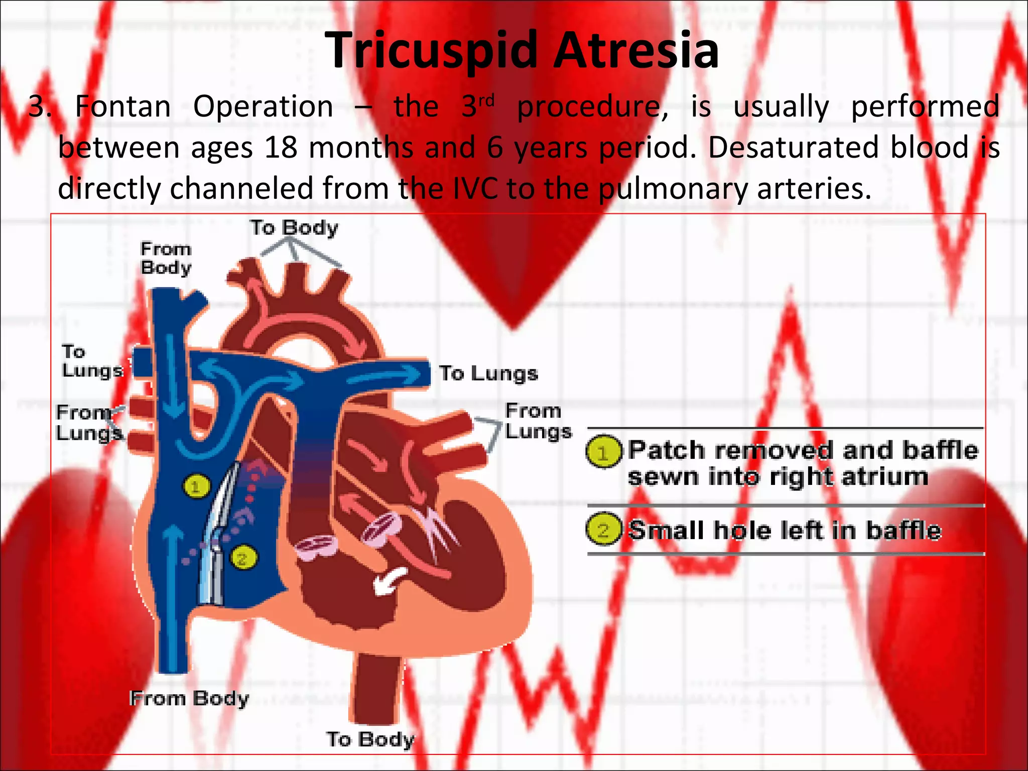Tricuspid Atresia 3. Fontan Operation – the 3 rd  procedure, is usually performed between ages 18 months and 6 years period. Desaturated blood is directly channeled from the IVC to the pulmonary arteries.  