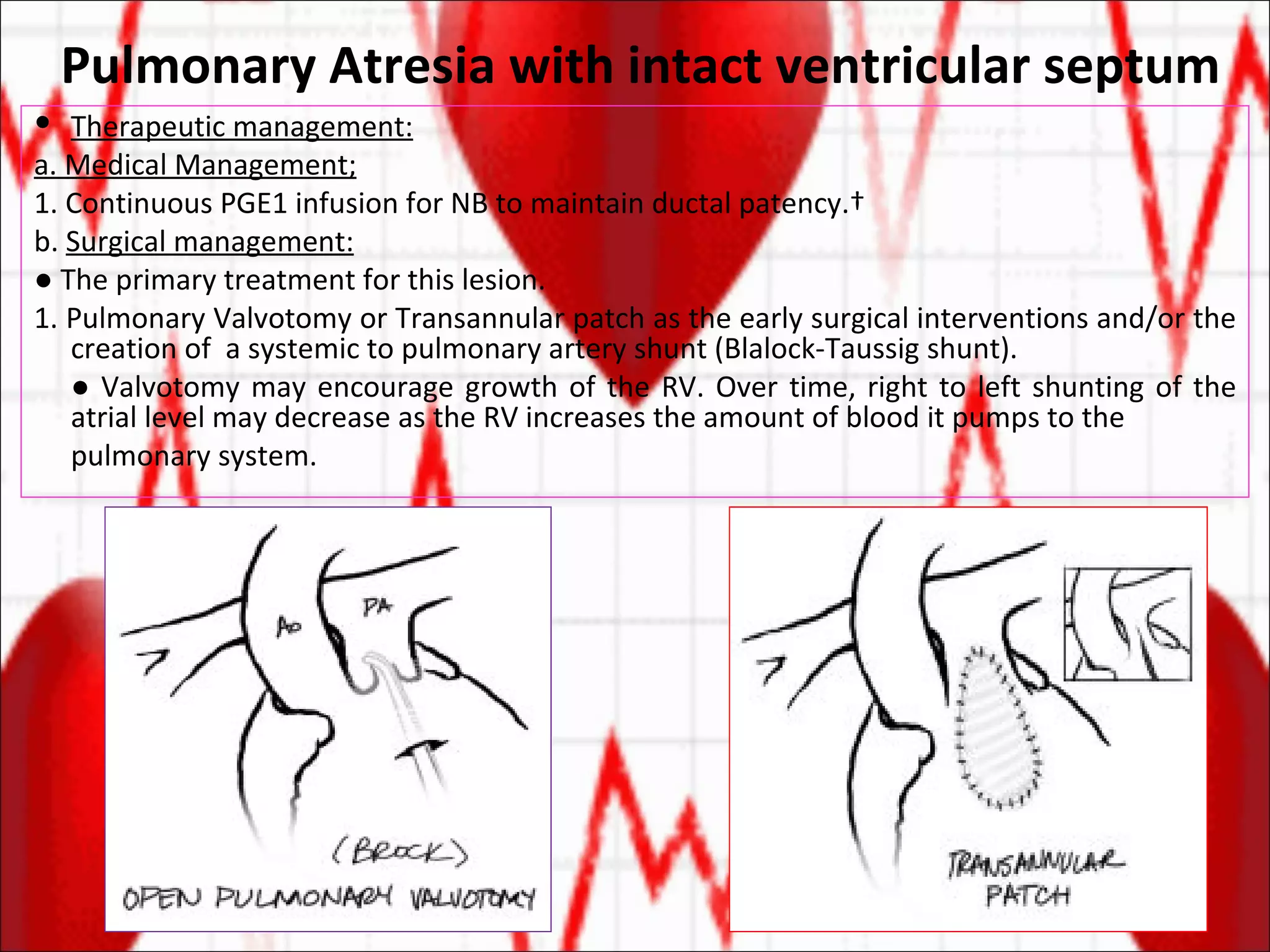 Pulmonary Atresia with intact ventricular septum Therapeutic management: a. Medical Management; 1. Continuous PGE1 infusion for NB to maintain ductal patency.  b.  Surgical management: ●  The primary treatment for this lesion. 1. Pulmonary Valvotomy or Transannular patch as the early surgical interventions and/or the creation of  a systemic to pulmonary artery shunt (Blalock-Taussig shunt). ●  Valvotomy may encourage growth of the RV. Over time, right to left shunting of the atrial level may decrease as the RV increases the amount of blood it pumps to the  pulmonary system.  
