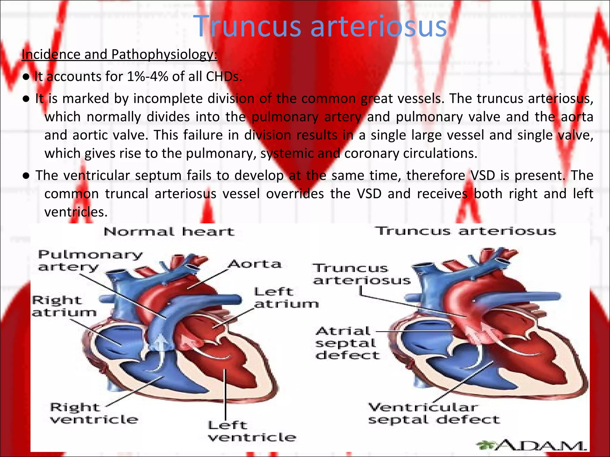 Truncus arteriosus Incidence and Pathophysiology: ●  It accounts for 1%-4% of all CHDs. ●  It is marked by incomplete division of the common great vessels. The truncus arteriosus, which normally divides into the pulmonary artery and pulmonary valve and the aorta and aortic valve. This failure in division results in a single large vessel and single valve, which gives rise to the pulmonary, systemic and coronary circulations. ●  The ventricular septum fails to develop at the same time, therefore VSD is present. The common truncal arteriosus vessel overrides the VSD and receives both right and left ventricles. 