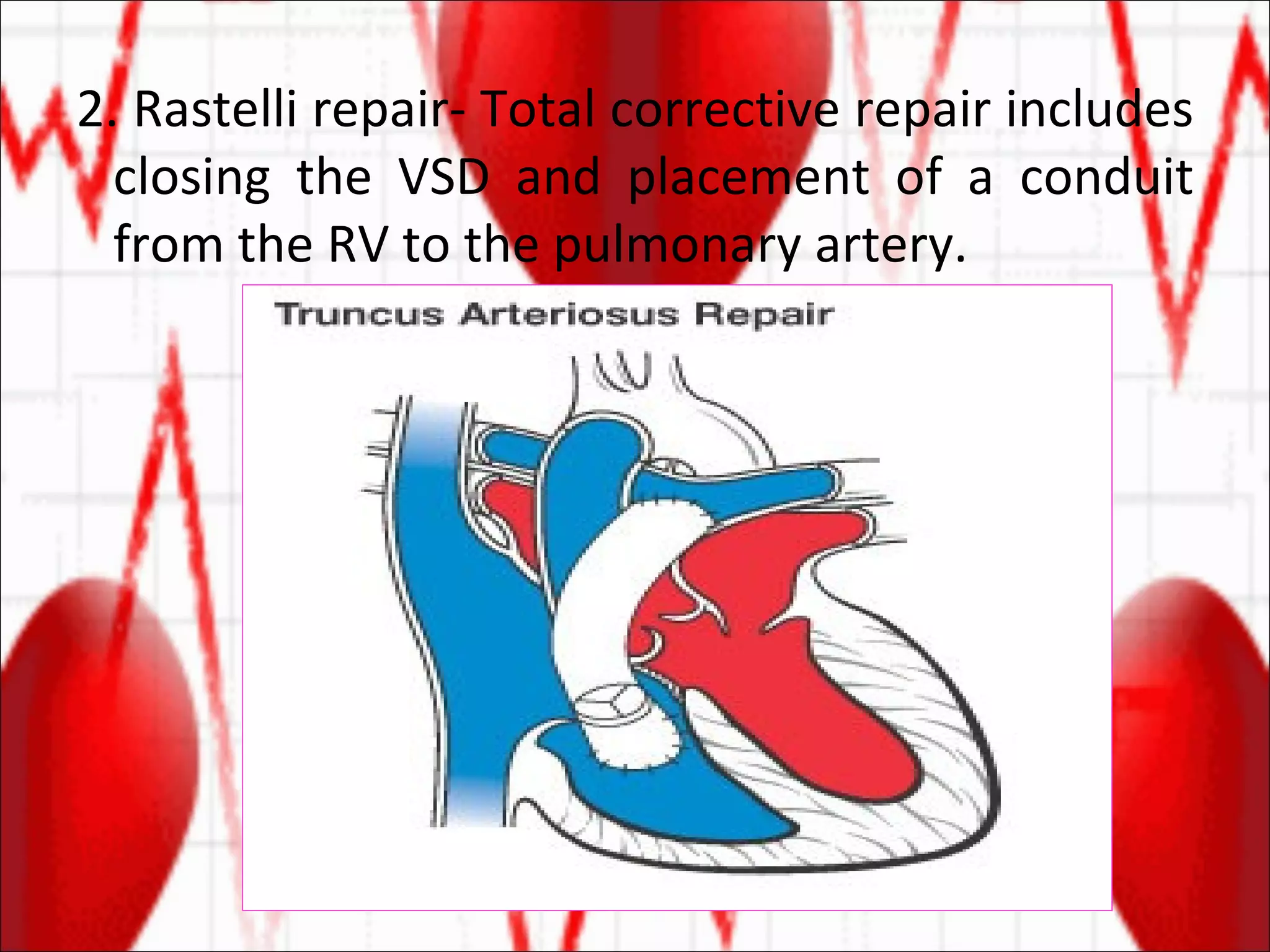 2. Rastelli repair- Total corrective repair includes closing the VSD and placement of a conduit from the RV to the pulmonary artery. 