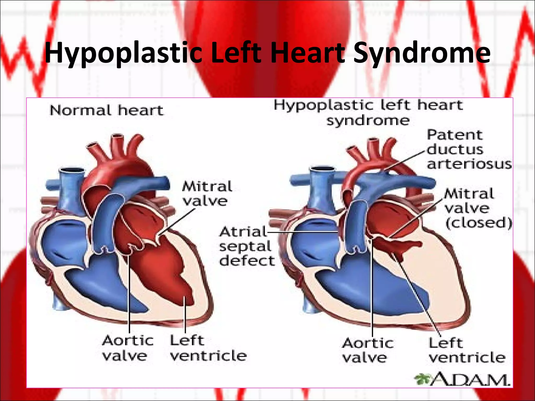 Hypoplastic Left Heart Syndrome 