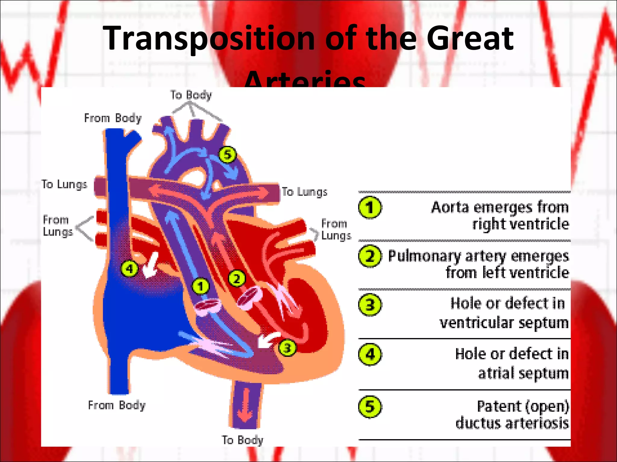 Transposition of the Great Arteries  