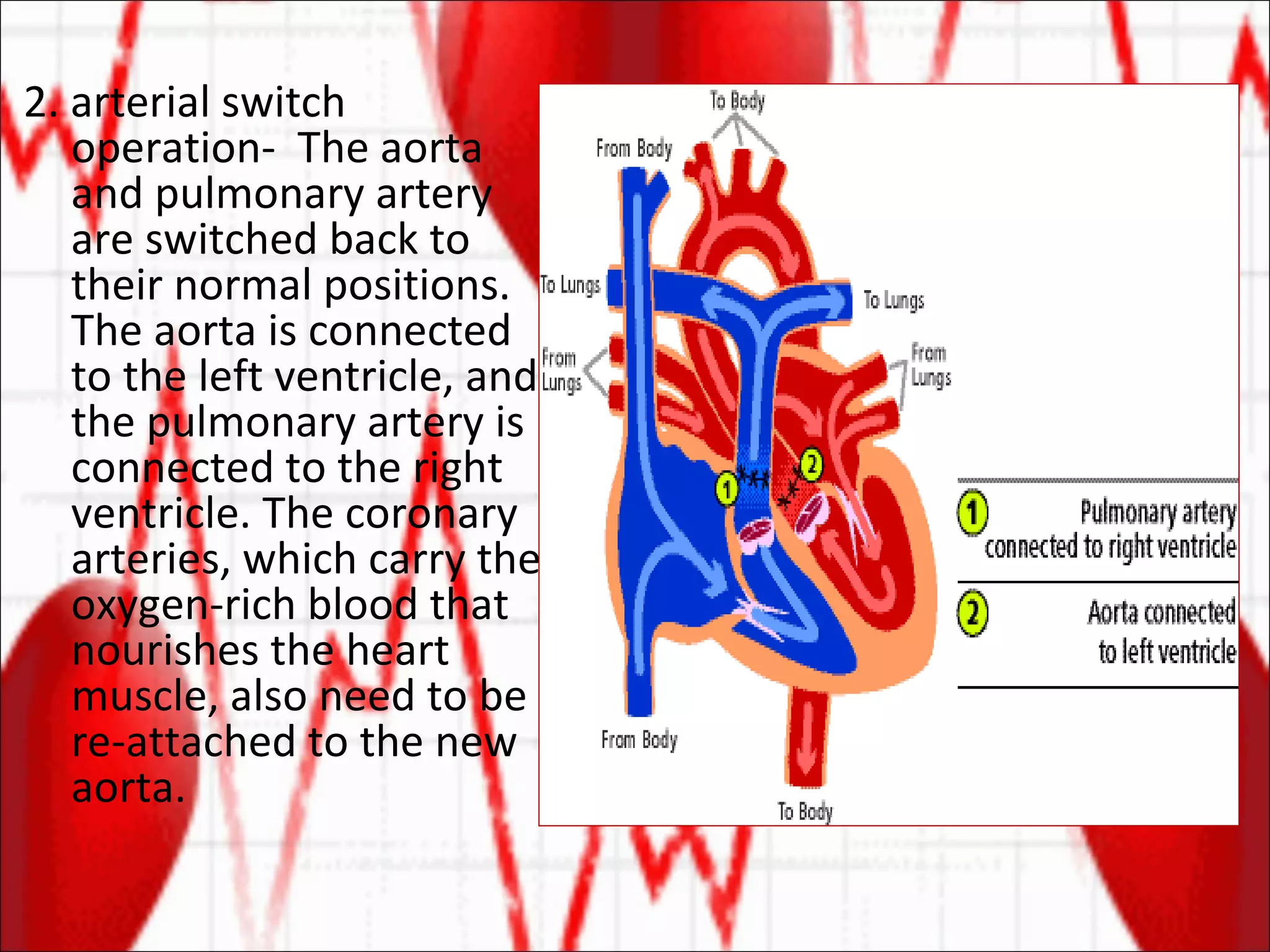 2. arterial switch operation-  The aorta and pulmonary artery are switched back to their normal positions. The aorta is connected to the left ventricle, and the pulmonary artery is connected to the right ventricle. The coronary arteries, which carry the oxygen-rich blood that nourishes the heart muscle, also need to be re-attached to the new aorta. 