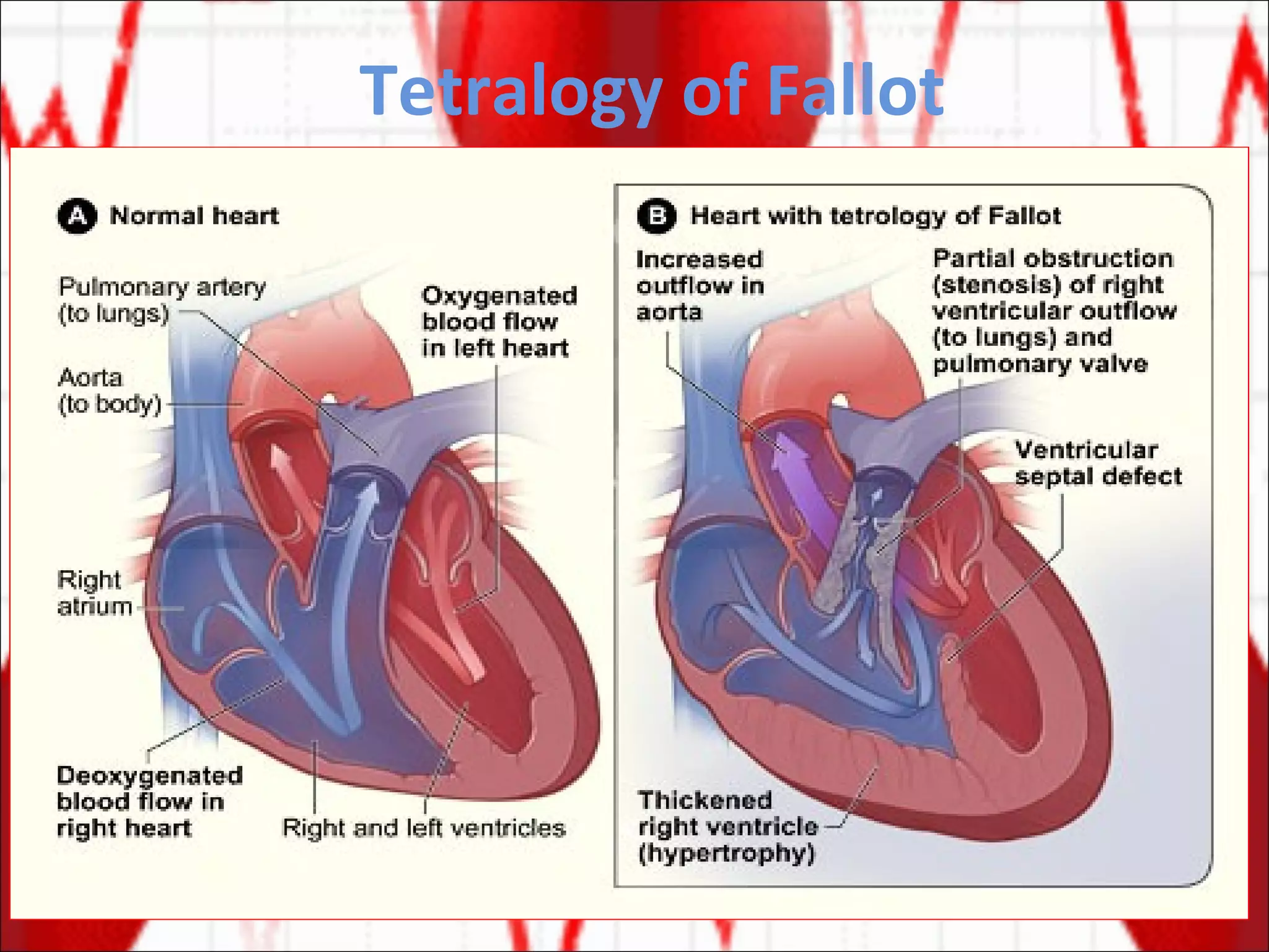 Tetralogy of Fallot 