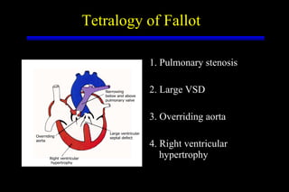 Tetralogy of Fallot 1. Pulmonary stenosis 2. Large VSD 3. Overriding aorta 4. Right ventricular hypertrophy 