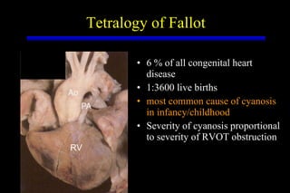 Tetralogy of Fallot 6 % of all congenital heart disease 1:3600 live births most common cause of cyanosis in infancy/childhood Severity of cyanosis proportional to severity of RVOT obstruction RV 