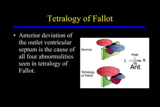 Tetralogy of Fallot Anterior deviation of the outlet ventricular septum is the cause of all four abnormalities seen in tetralogy of Fallot. 