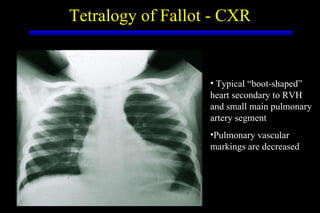 Tetralogy of Fallot - CXR Typical “boot-shaped” heart secondary to RVH and small main pulmonary artery segment Pulmonary vascular markings are decreased 