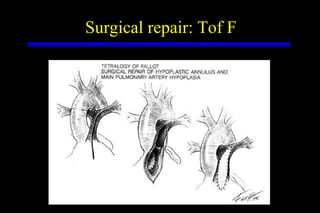 Surgical repair: Tof F 