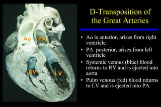 D-Transposition of the Great Arteries Ao is anterior, arises from right ventricle PA  posterior, arises from left ventricle Systemic venous (blue) blood returns to RV and is ejected into aorta Pulm venous (red) blood returns to LV and is ejected into PA RV LV PA Ao 