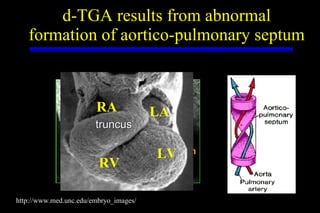 d-TGA results from abnormal formation of aortico-pulmonary septum http://www.med.unc.edu/embryo_images/ PA AO cushion LV RV LA RA truncus 