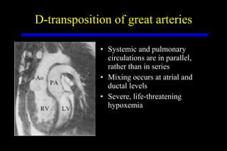 D-transposition of great arteries Systemic and pulmonary circulations are in parallel, rather than in series Mixing occurs at atrial and ductal levels Severe, life-threatening hypoxemia 