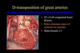 D-transposition of great arteries 5% of all congenital heart disease Most common cause of cyanosis in neonate Male:female 2:1 RV Ao PA RA LA 