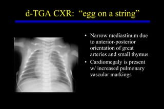 Narrow mediastinum due to anterior-posterior orientation of great arteries and small thymus  Cardiomegaly is present w/ increased pulmonary vascular markings d-TGA CXR:  “egg on a string” 