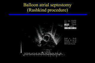 Balloon atrial septostomy (Rashkind procedure) 