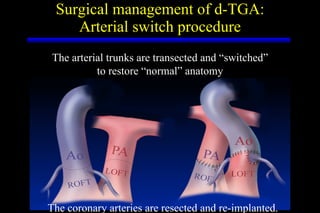 Surgical management of d-TGA: Arterial switch procedure The arterial trunks are transected and “switched” to restore “normal” anatomy The coronary arteries are resected and re-implanted. 