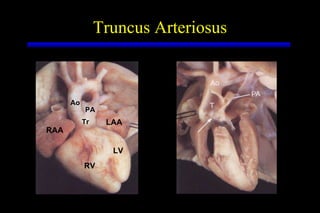 Truncus Arteriosus RV LV RAA LAA PA Ao Tr 