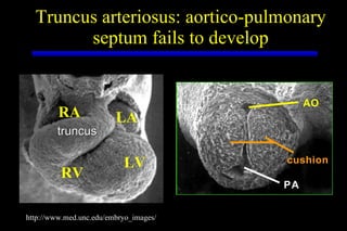 Truncus arteriosus: aortico-pulmonary septum fails to develop http://www.med.unc.edu/embryo_images/ PA AO cushion LV RV LA RA truncus 