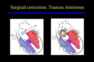 Surgical correction: Truncus Arteriosus 