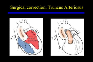 Surgical correction: Truncus Arteriosus 