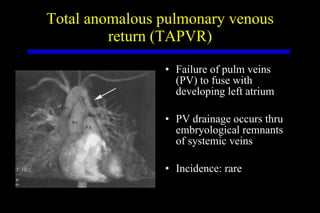 Total anomalous pulmonary venous return (TAPVR) Failure of pulm veins (PV) to fuse with developing left atrium PV drainage occurs thru embryological remnants of systemic veins Incidence: rare 