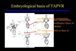Embryological basis of TAPVR Systemic venous connections reabsorb as PV confluence fuses w/ left atrium PV confluence PV confluence fails to fuse w/ left atrium Systemic venous connections persist 
