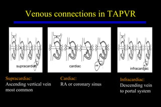 Venous connections in TAPVR Supracardiac: Ascending vertical vein most common Cardiac: RA or coronary sinus Infracardiac: Descending vein to portal system supracardiac cardiac infracardiac 