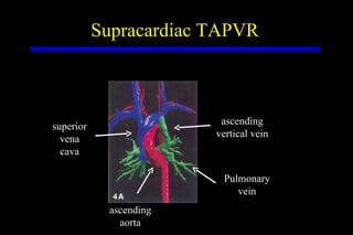 Supracardiac TAPVR Pulmonary vein ascending vertical vein superior vena cava ascending aorta 