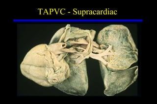 TAPVC - Supracardiac  