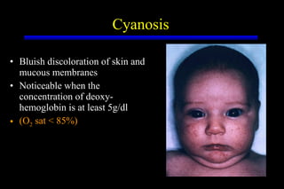 Cyanosis Bluish discoloration of skin and mucous membranes Noticeable when the concentration of deoxy-hemoglobin is at least 5g/dl  (O 2  sat < 85%) 