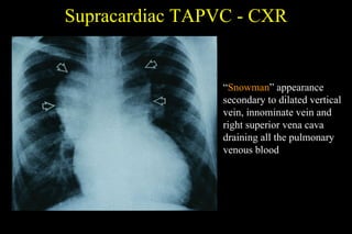 Supracardiac TAPVC - CXR “ Snowman ” appearance secondary to dilated vertical vein, innominate vein and right superior vena cava draining all the pulmonary venous blood 