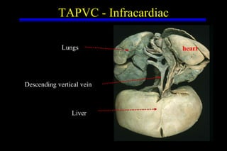 TAPVC - Infracardiac Lungs Descending vertical vein Liver heart 