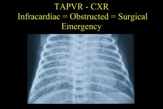 TAPVR - CXR  Infracardiac = Obstructed = Surgical Emergency 