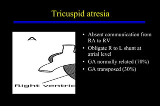 Tricuspid atresia Absent communication from RA to RV Obligate R to L shunt at atrial level GA normally related (70%) GA transposed (30%) 