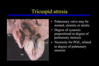 Tricuspid atresia Pulmonary valve may be normal, stenotic or atretic Degree of cyanosis proportional to degree of pulmonary stenosis Necessity for PGE 1  related to degree of pulmonary stenosis 
