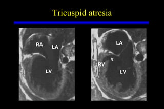 Tricuspid atresia RA LA LV LA LV RV 