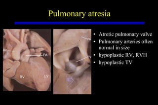 Pulmonary atresia Atretic pulmonary valve Pulmonary arteries often normal in size hypoplastic RV, RVH hypoplastic TV 