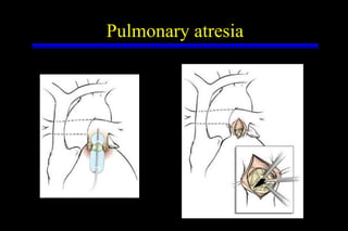 Pulmonary atresia 
