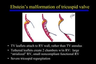 Ebstein’s malformation of tricuspid valve TV leaflets attach to RV wall, rather than TV annulus Tethered leaflets create 2 chambers w/in RV:  large “atrialized” RV, small noncompliant functional RV Severe tricuspid regurgitation 