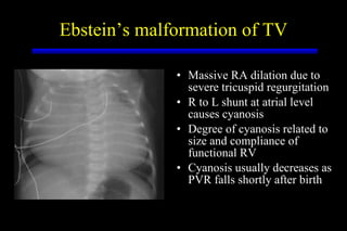 Ebstein’s malformation of TV Massive RA dilation due to severe tricuspid regurgitation R to L shunt at atrial level causes cyanosis Degree of cyanosis related to size and compliance of functional RV Cyanosis usually decreases as PVR falls shortly after birth 