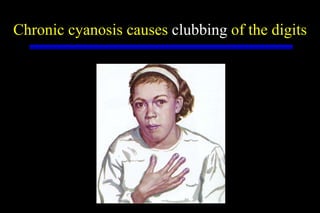 Chronic cyanosis causes  clubbing  of the digits 