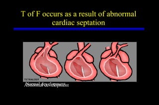 T of F occurs as a result of abnormal  cardiac septation  Normal development Abnormal development 