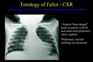 Tetralogy of Fallot - CXR <ul><li>Typical “boot-shaped” heart secondary to RVH and small main pulmonary artery segment </l...