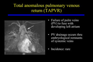 Total anomalous pulmonary venous return (TAPVR) <ul><li>Failure of pulm veins (PV) to fuse with developing left atrium </l...