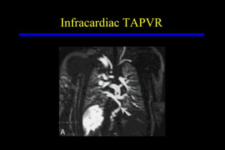 Infracardiac TAPVR 