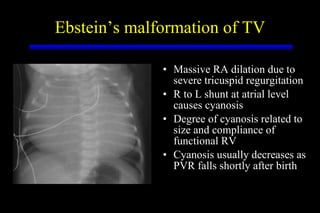 Ebstein’s malformation of TV <ul><li>Massive RA dilation due to severe tricuspid regurgitation </li></ul><ul><li>R to L sh...