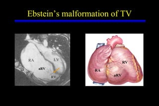 Ebstein’s malformation of TV RA aRV RV aRV 